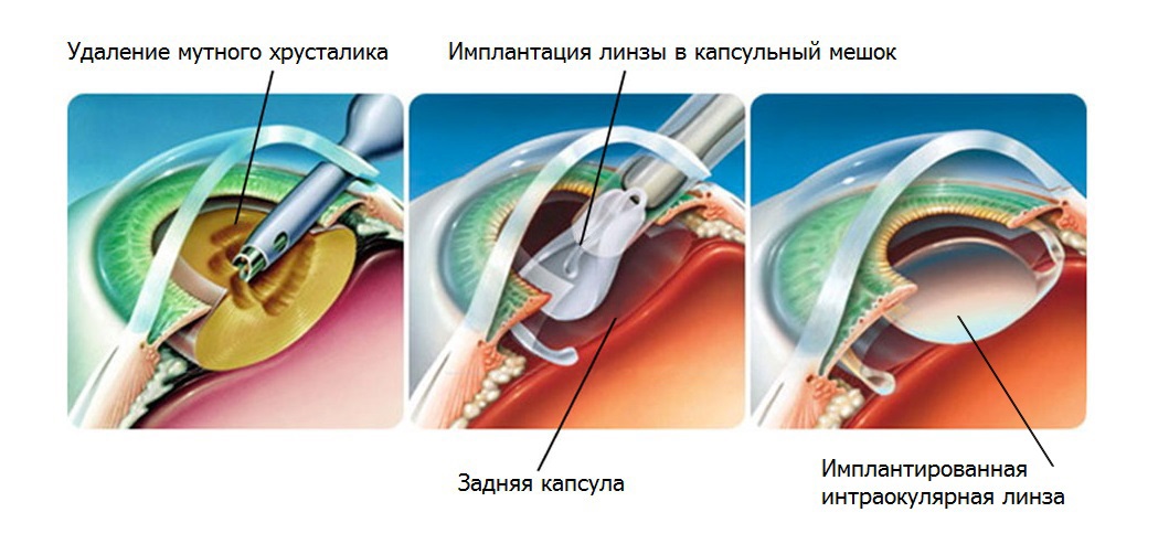 реабилитация после операции на катаракту